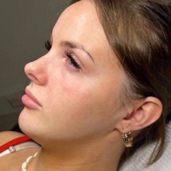 Before treatment